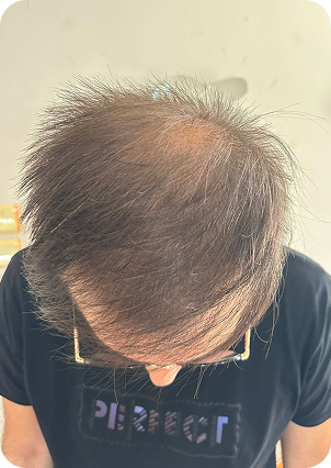 قبل وبعد زراعة الشعر في تركيا