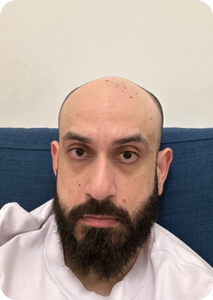 قبل وبعد زراعة الشعر في تركيا
