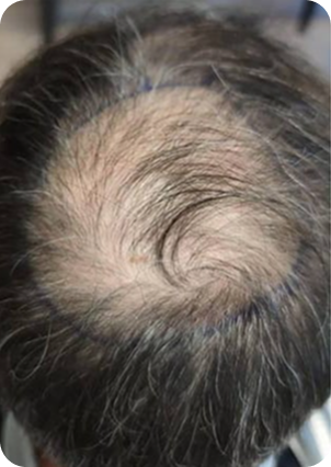 قبل وبعد زراعة الشعر في تركيا