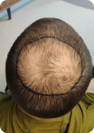 قبل وبعد زراعة الشعر في تركيا