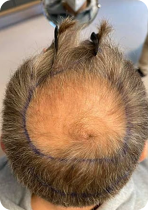 قبل وبعد زراعة الشعر في تركيا