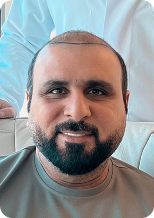 قبل وبعد زراعة الشعر في تركيا