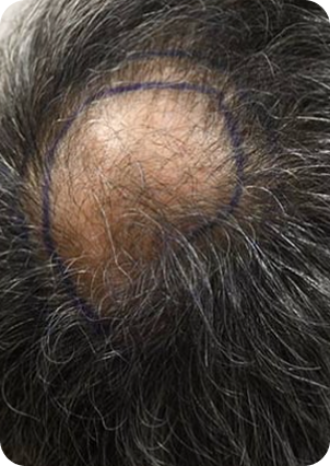 قبل وبعد زراعة الشعر في تركيا