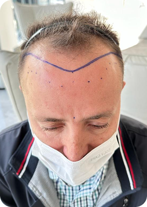 قبل وبعد زراعة الشعر في تركيا