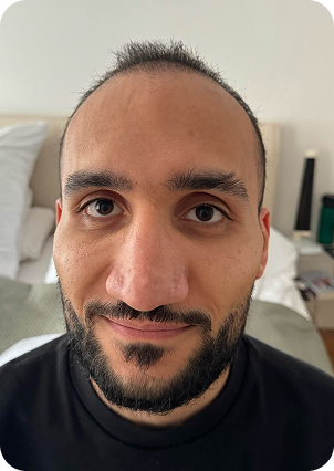 قبل وبعد زراعة الشعر في تركيا