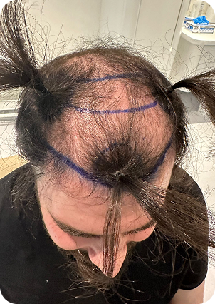 قبل وبعد زراعة الشعر في تركيا