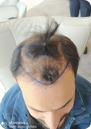 قبل وبعد زراعة الشعر في تركيا