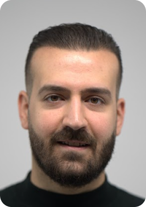 بعد زراعة الشعر في تركيا