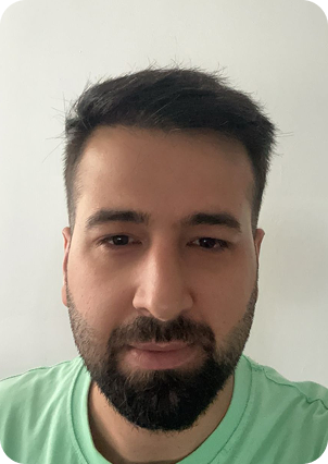 قبل وبعد زراعة الشعر في تركيا