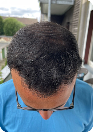 قبل وبعد زراعة الشعر في تركيا