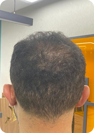 قبل وبعد زراعة الشعر في تركيا