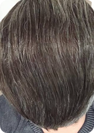 قبل وبعد زراعة الشعر في تركيا