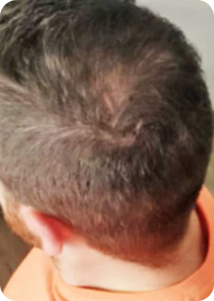 قبل وبعد زراعة الشعر في تركيا