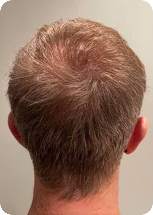 قبل وبعد زراعة الشعر في تركيا