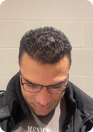 قبل وبعد زراعة الشعر في تركيا