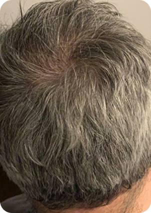 قبل وبعد زراعة الشعر في تركيا
