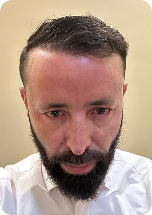 قبل وبعد زراعة الشعر في تركيا
