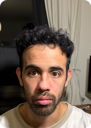 قبل وبعد زراعة الشعر في تركيا