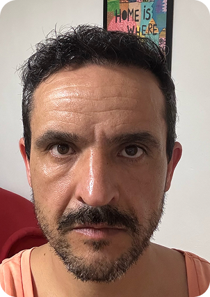 قبل وبعد زراعة الشعر في تركيا