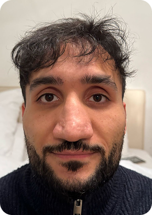 قبل وبعد زراعة الشعر في تركيا