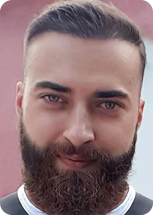 قبل وبعد زراعة اللحية في تركيا