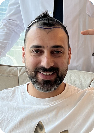 أحمد الصادق قبل زراعة الشعر في تركيا