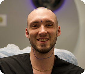 إيقاظ المريض من النوم ليقوم خبراء زراعة الشعر لدينا بإجراء الزراعة بشكل مريح وخالي من الألم