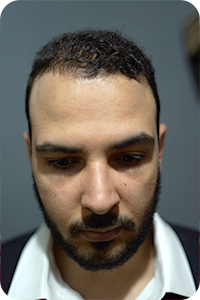 بعد 6 أشهر زراعة الشعر بتقنية البيركوتان