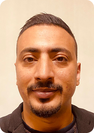 قبل وبعد زراعة الشعر في تركيا
