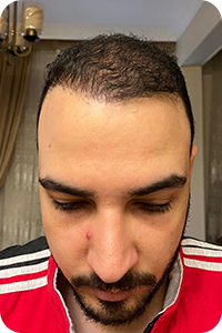 بعد شهرين زراعة الشعر بتقنية البيركوتان