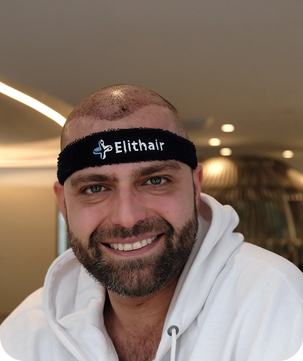 مريض في أليت هير بعد إجراء عملية زراعة شعر ناجحة بتقنية البيركوتان