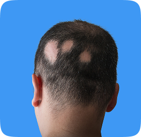شخص يعاني من الثعلبة البقعية في مركز زراعة الشعر