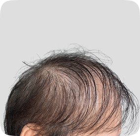 زراعة الشعر للرجال في تركيا لمعالجة الشعر الخفيف
