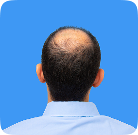 تساقط الشعر في منطقة التاج والحل مع زراعة الشعر للرجال