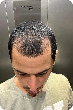 بعد شهرين من زراعة الشعر في تركيا ، زراعة الشعر للرجال