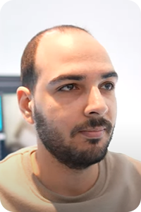 قبل زراعة الشعر بتقنية البيركوتان