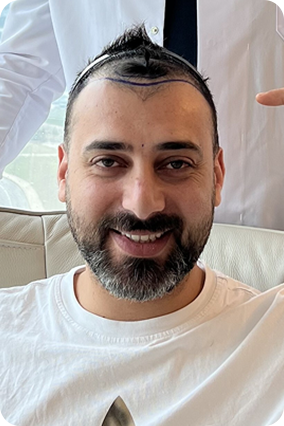 اليوتيوبر أحمد الصادق قبل زراعة الشعر وحقن البلازما