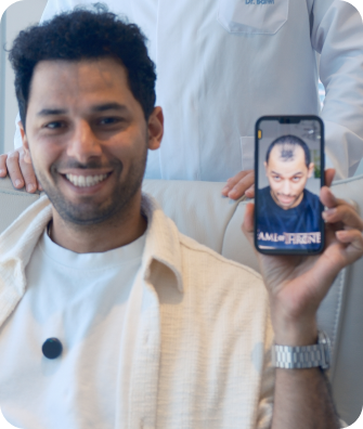 كريم رافع قبل وبعد زراعة الشعر