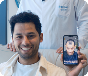 نتائج زراعة الشعر في أليت هير قبل وبعد