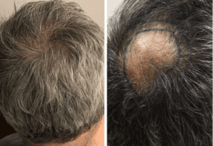 نتائج زراعة الشعر في مشفى اليت هير