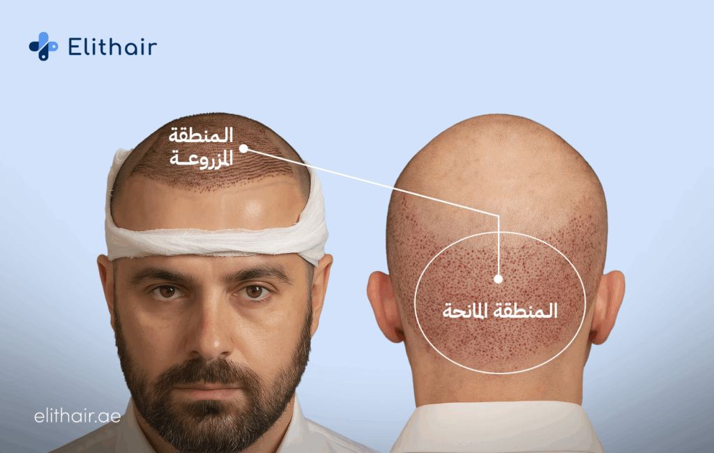 المنطقة المانحة والمزروعة - مركز اليت هير لزراعة الشعر