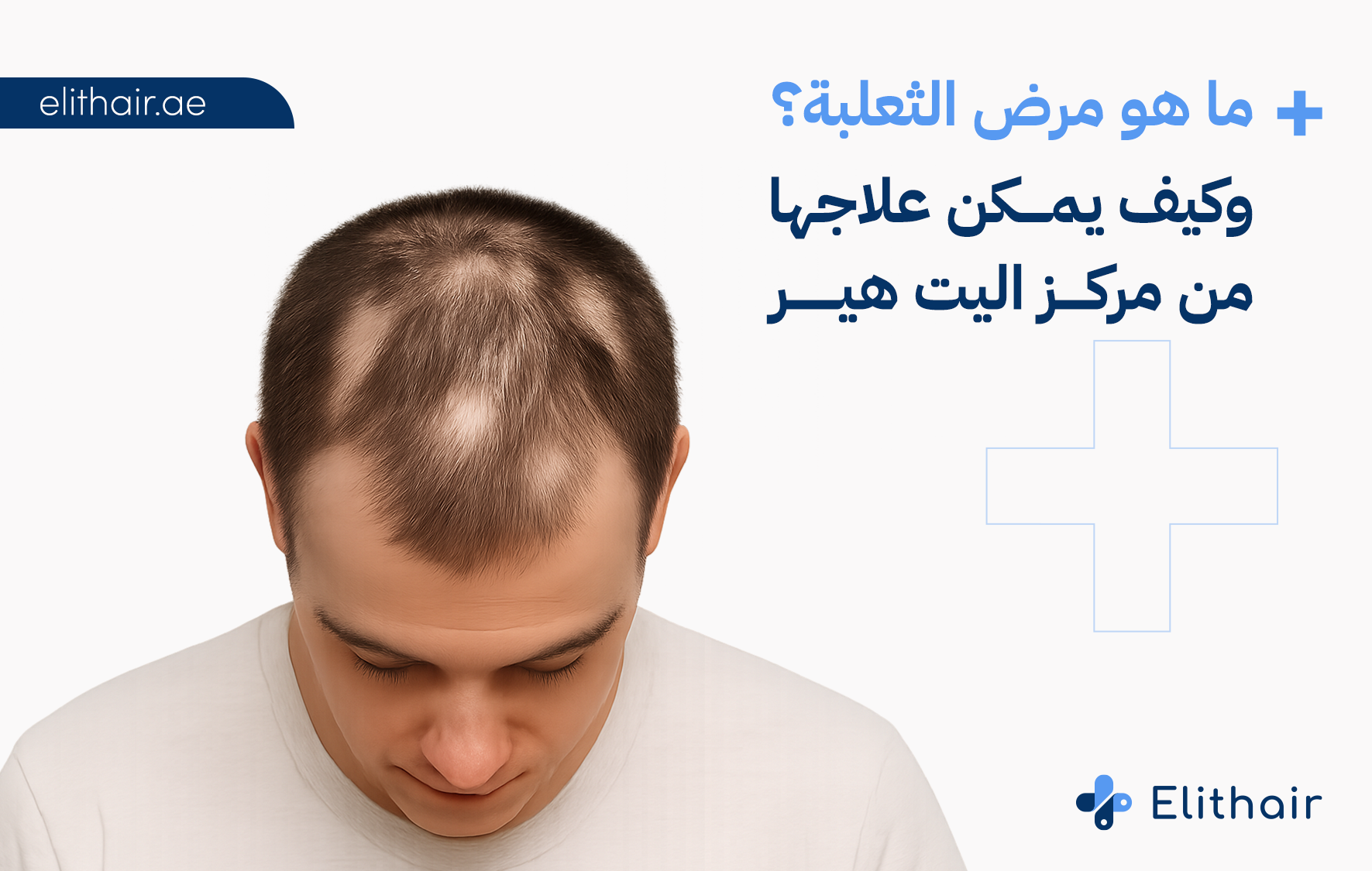 علاج الثعلبة: زراعة الشعر في تركيا