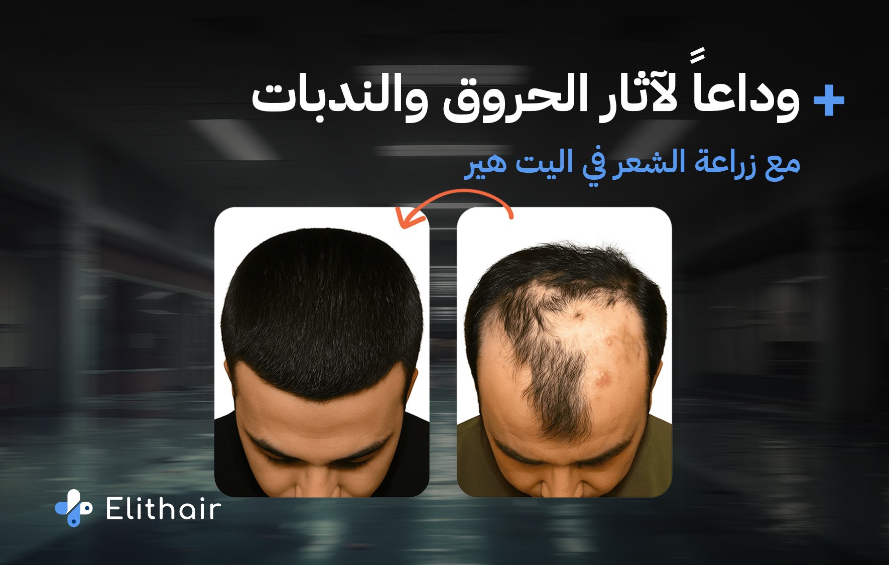 زراعة الشعر في الحروق والتدبات - مركز اليت هير لزراعة الشعر