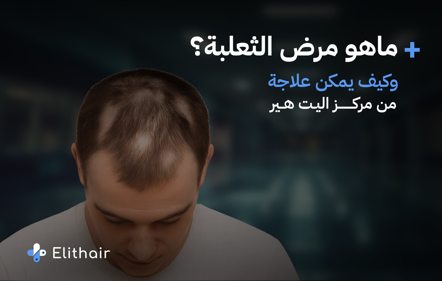 علاج الثعلبة: زراعة الشعر في تركيا