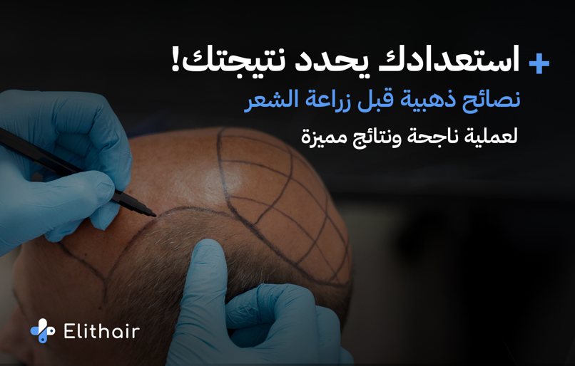 نصائح لزراعة شعر ناجحة - مركز اليت هير لزراعة الشعر