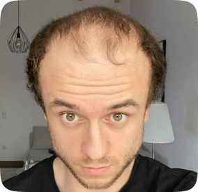 زراعة الشعر في أماكن الندبات والحروق