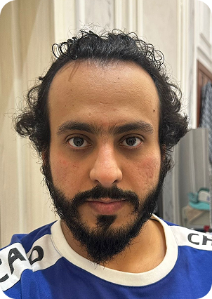 السيد إبراهيم قبل زراعة الشعر في تركيا