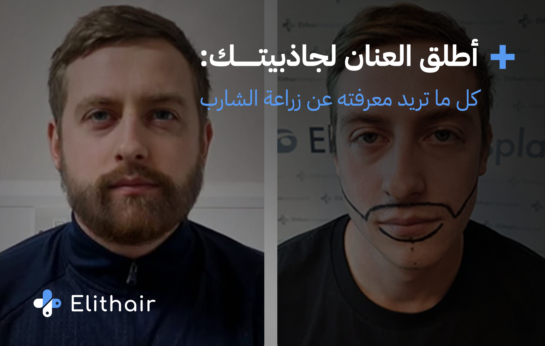 زراعة الشارب في تركيا في اليت هير