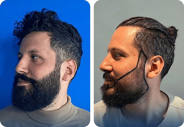 نتائج زراعة الشعر للسيد يزان - مركز اليت هير لزراعة الشعر