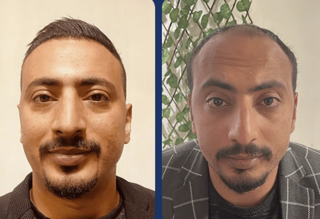 نتائج زراعة الشعر للسيد محمد - مركز اليت هير لزراعة الشعر